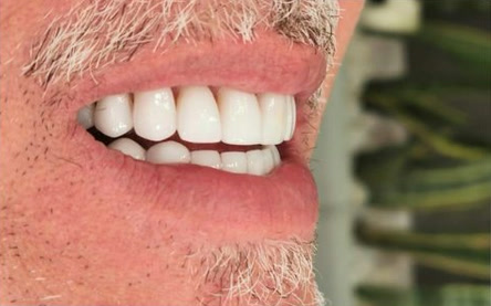 Sonrisa con carillas en cerámica, vista lateral