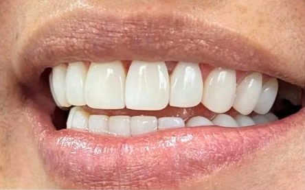 Sonrisa con carillas en resina, vista frontal